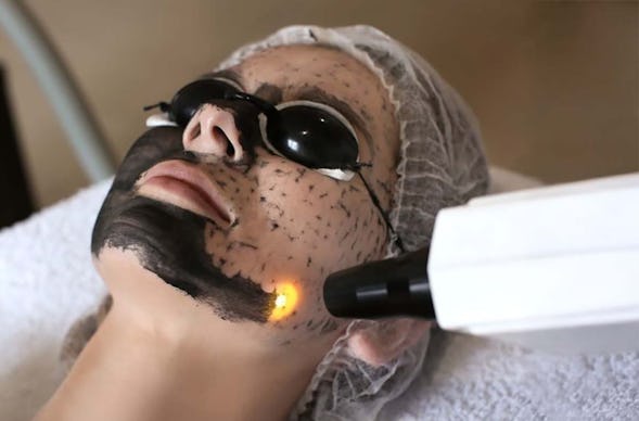 Carbon Peeling München